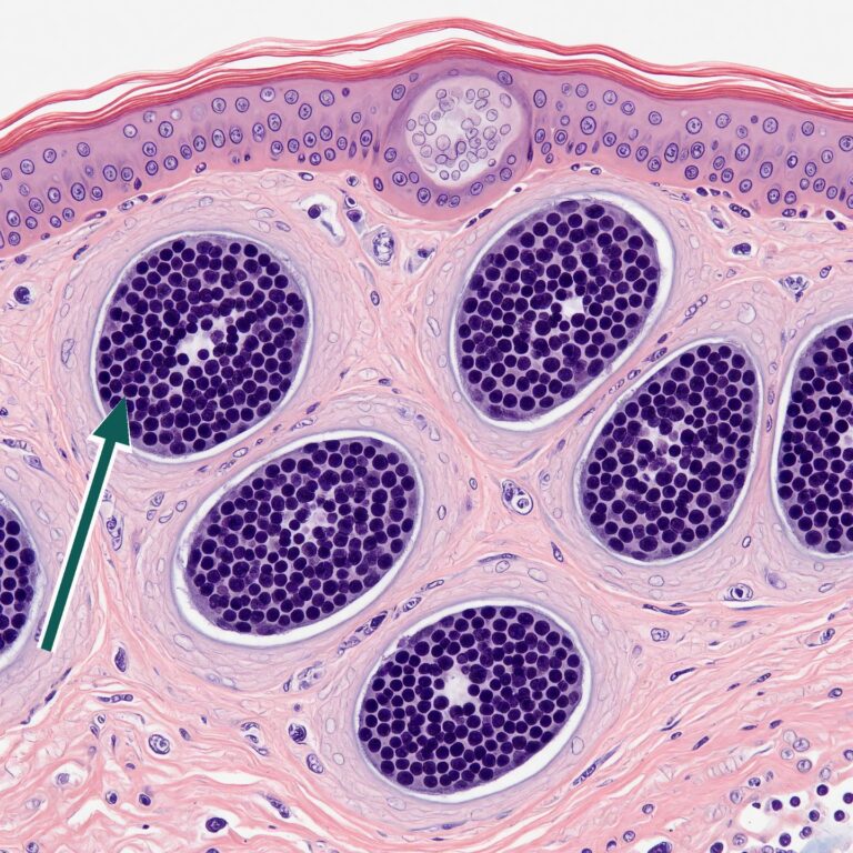 Células de carcinoma basocelular vistas ao microscópio, com uma seta apontando um ninho de células tumorais.