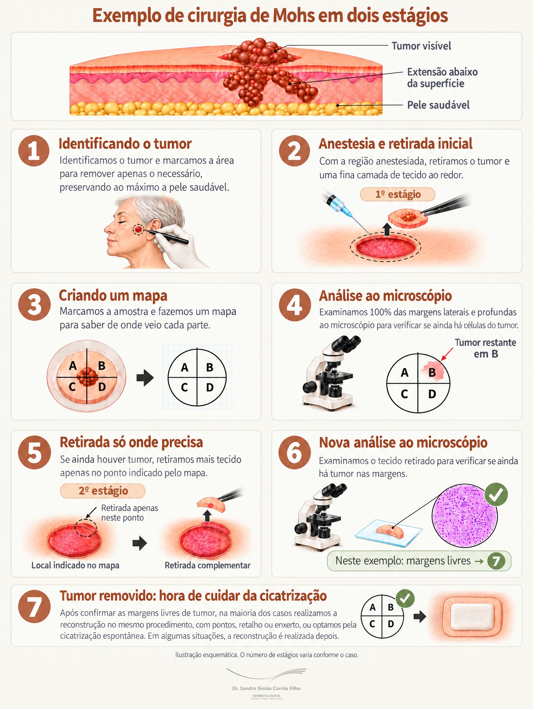 Infográfico: exemplo de Cirurgia de Mohs em dois estágios: identificação do tumor, anestesia e retirada inicial, mapa da amostra, análise de 100% das margens ao microscópio, nova retirada apenas no ponto com tumor, nova análise com margens livres e fechamento da ferida