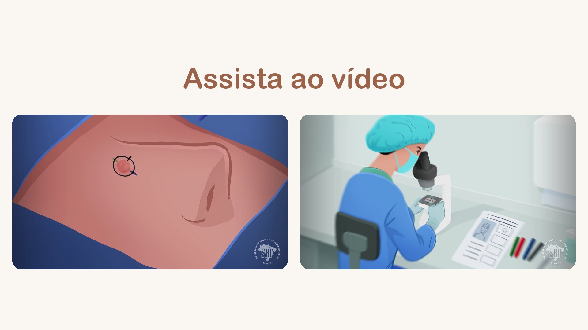 Capa do vídeo O que é a Cirurgia de Mohs?